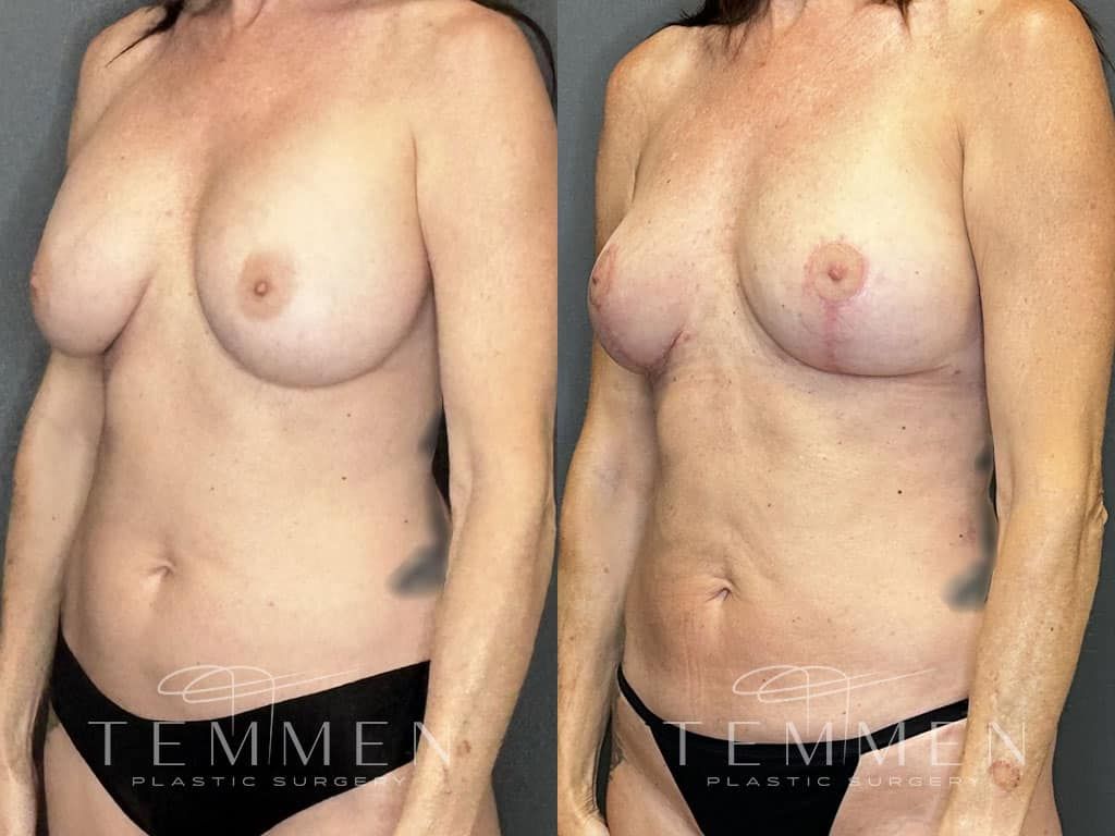 Breast Implant Removal Breast Lift Liposuction Fat Transfer To The Breasts And Tummy Tuck Before & After