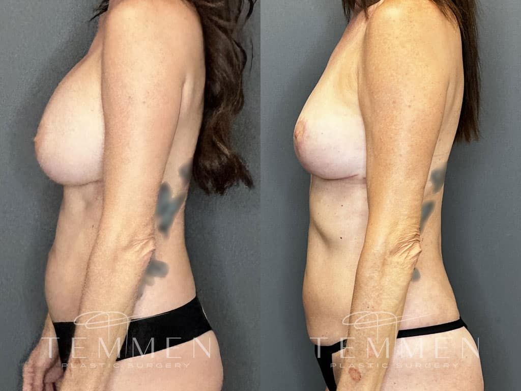 Breast Implant Removal Breast Lift Liposuction Fat Transfer To The Breasts And Tummy Tuck Before & After