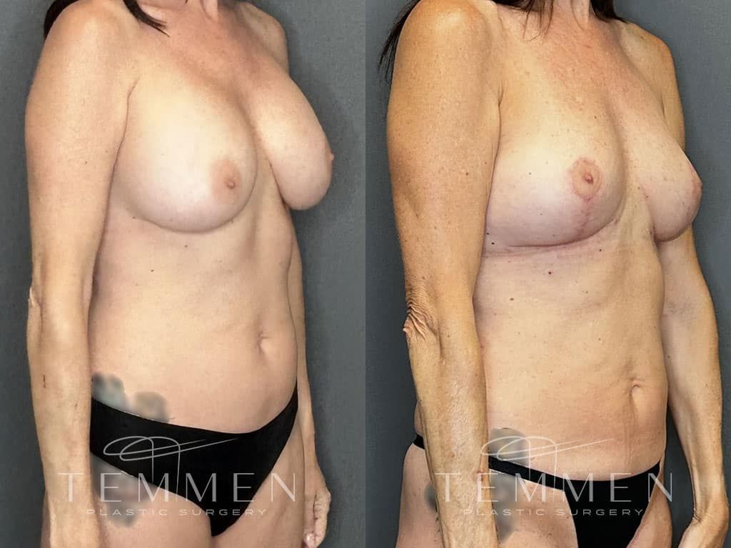 Breast Implant Removal Breast Lift Liposuction Fat Transfer To The Breasts And Tummy Tuck Before & After