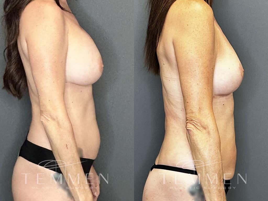 Breast Implant Removal Breast Lift Liposuction Fat Transfer To The Breasts And Tummy Tuck Before & After