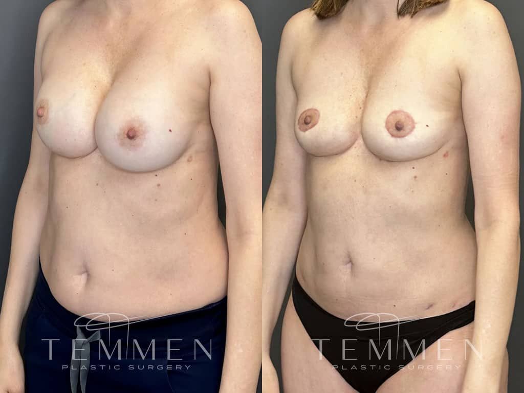 Breast Implant Removal Breast Lift Liposuction Fat Transfer To The Breasts And Tummy Tuck Before & After