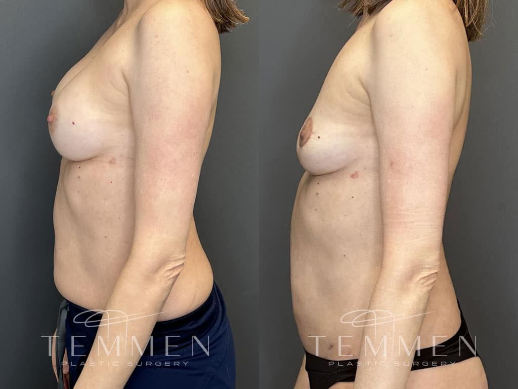 Breast Implant Removal Breast Lift Liposuction Fat Transfer To The Breasts And Tummy Tuck Before & After