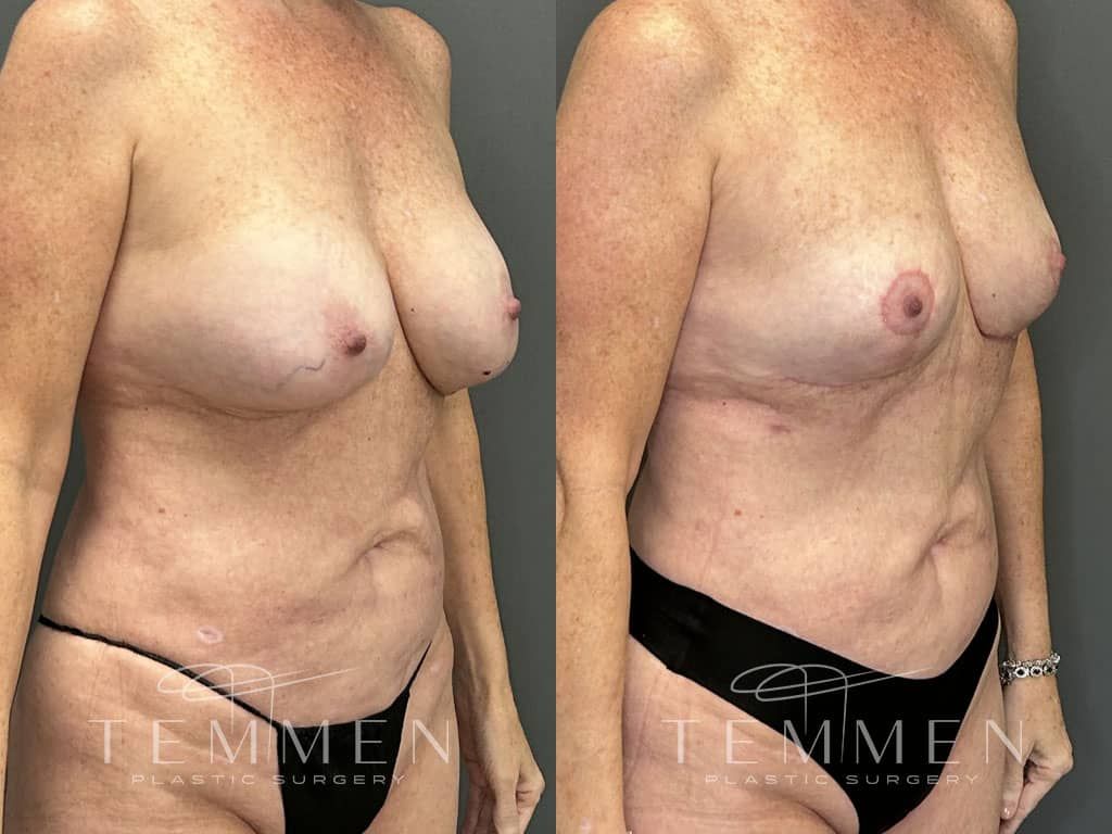 Breast Implant Removal Breast Lift Liposuction Fat Transfer To The Breasts And Tummy Tuck Before & After