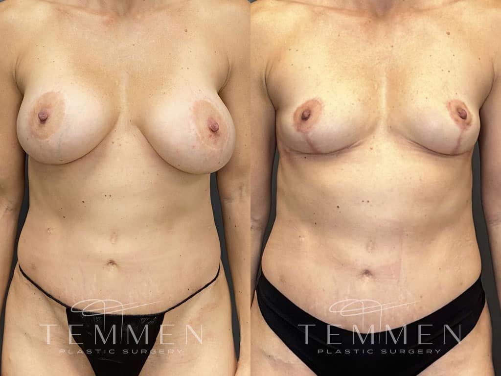 Breast Implant Removal Breast Lift Liposuction Fat Transfer To The Breasts And Tummy Tuck Before & After
