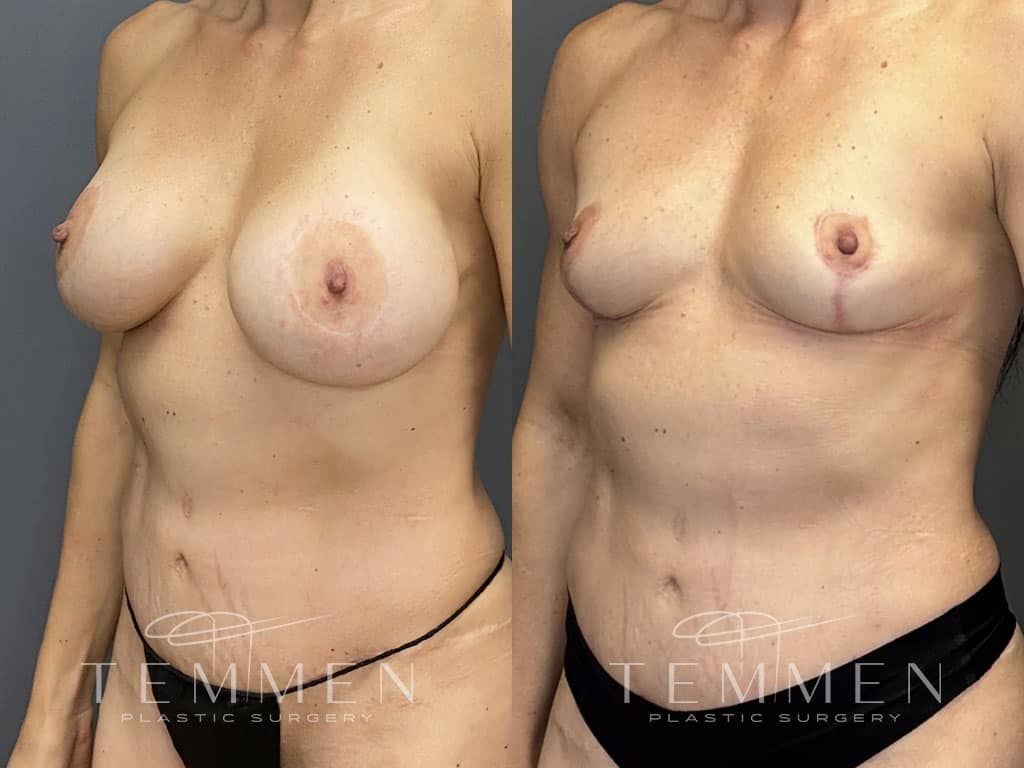 Breast Implant Removal Breast Lift Liposuction Fat Transfer To The Breasts And Tummy Tuck Before & After