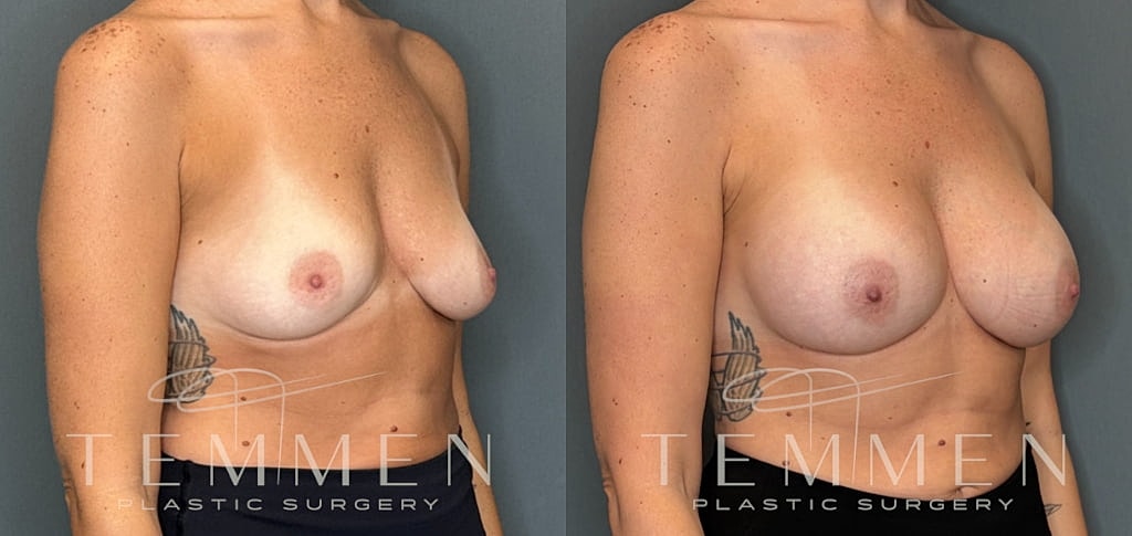 Small Breast Augmentation Before & After