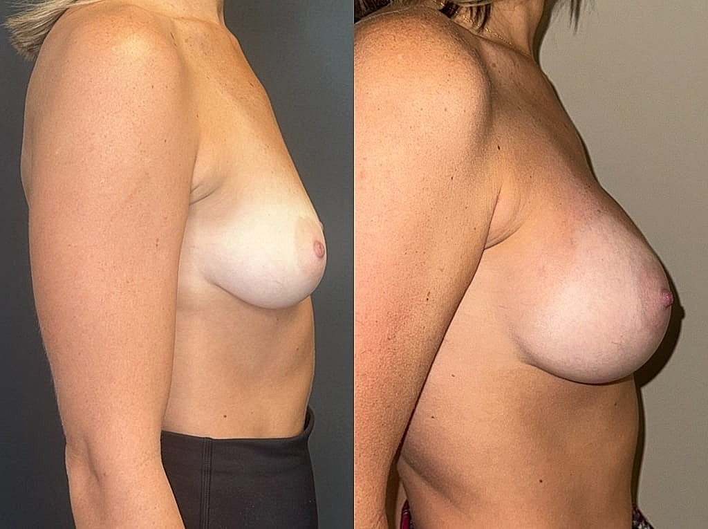 Before and after breast augmentation comparison photo