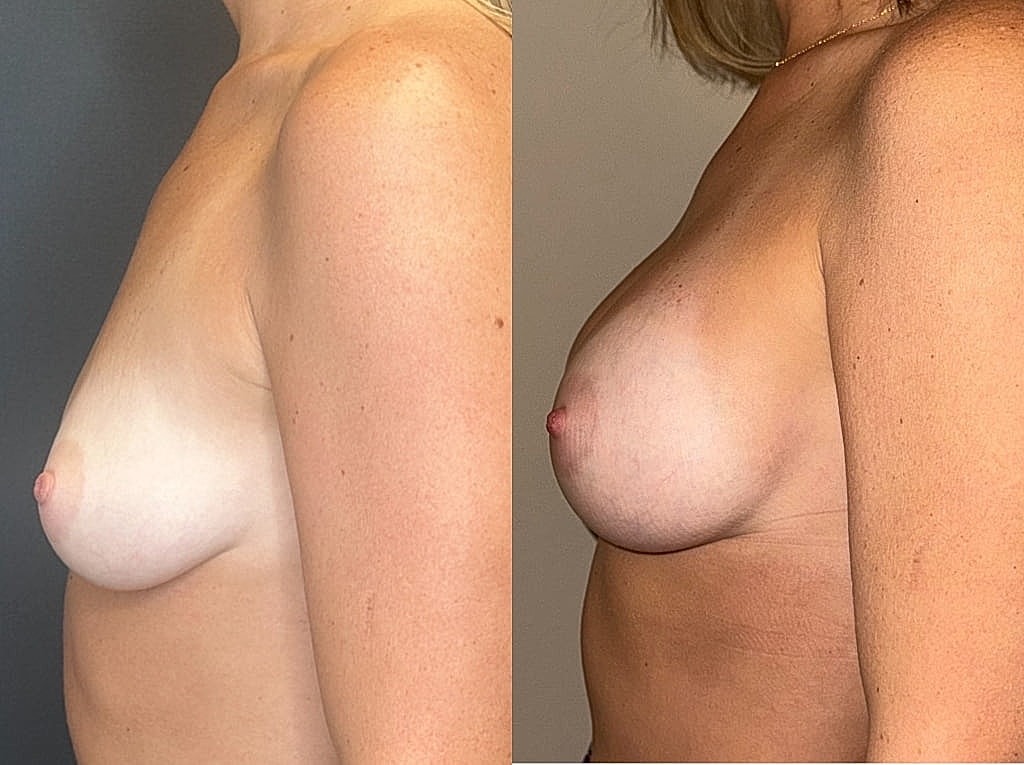Before and after breast enhancement comparison image.