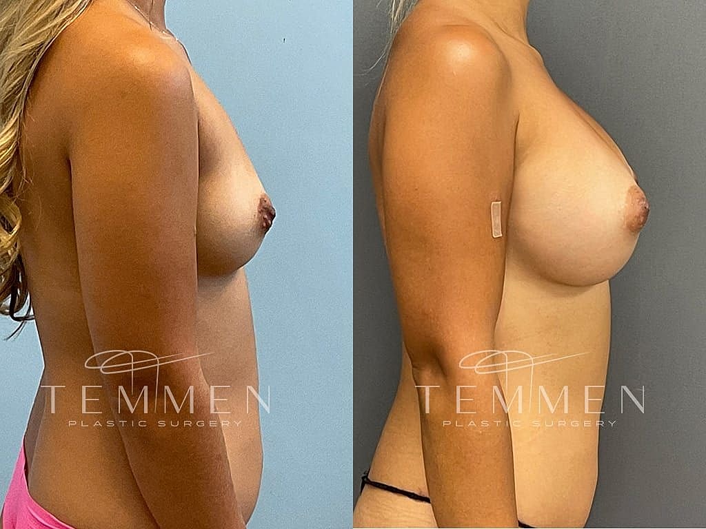 Before and after breast augmentation results.