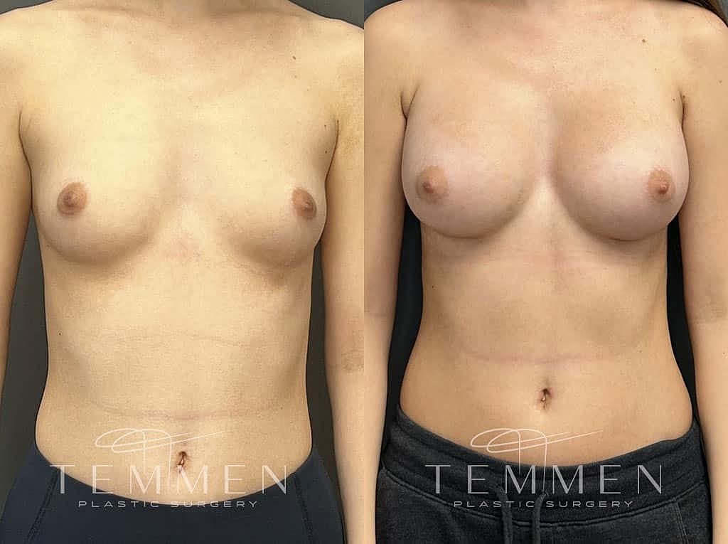 Before and after breast enhancement surgery comparison.
