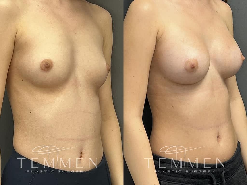 Before and after breast augmentation comparison.