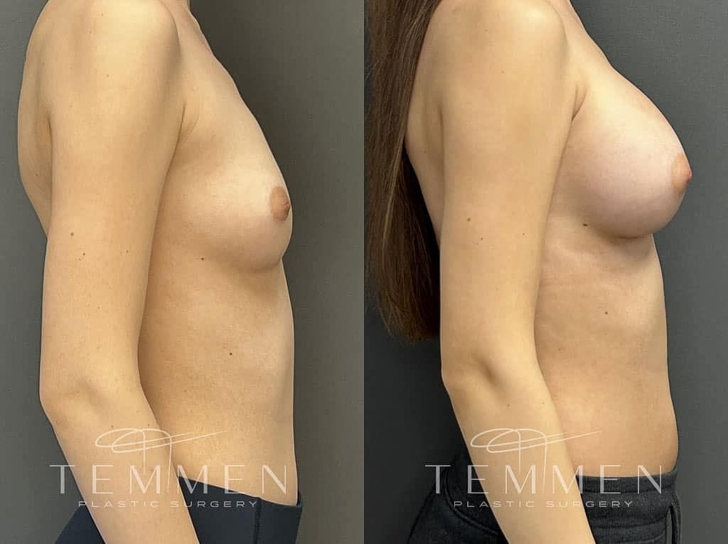 Before and after breast augmentation comparison.
