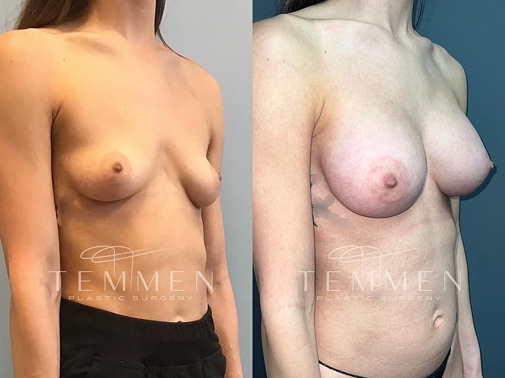 Before and after breast enhancement surgery comparison.