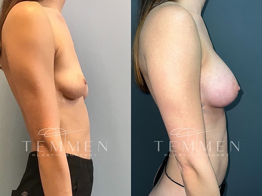 Before and after breast enhancement surgery.
