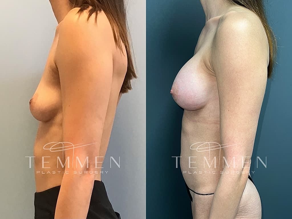 Before and after breast enhancement comparison.