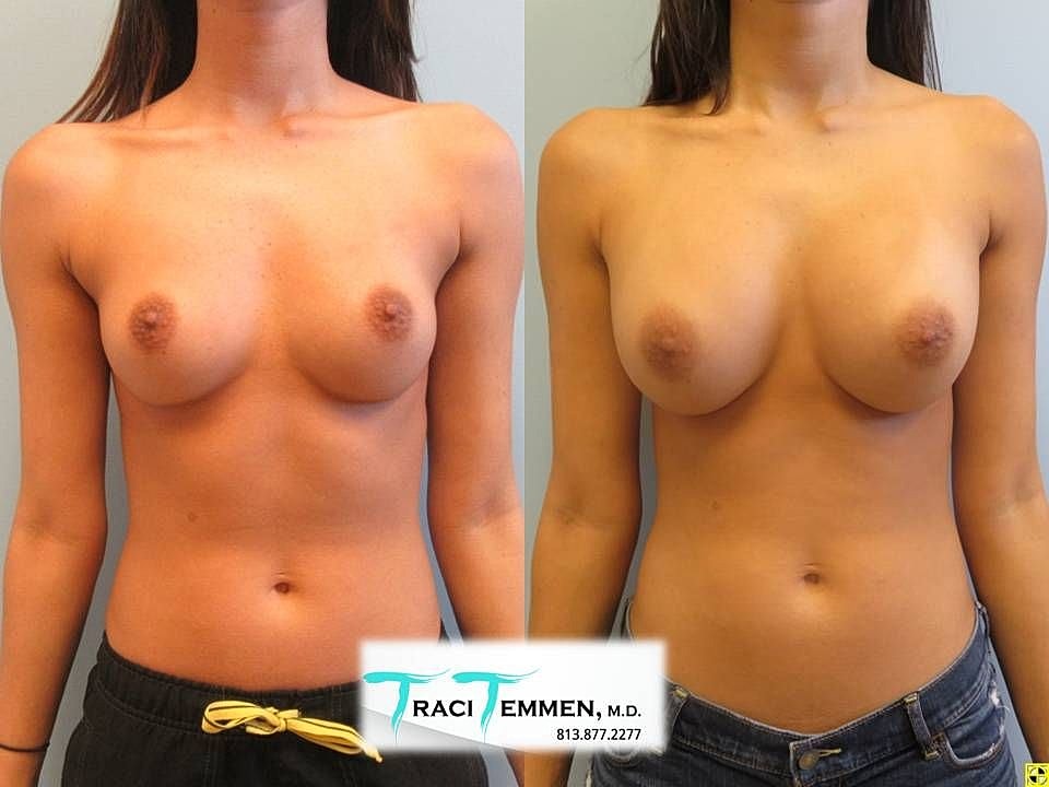 Before and after breast enhancement comparison photo.