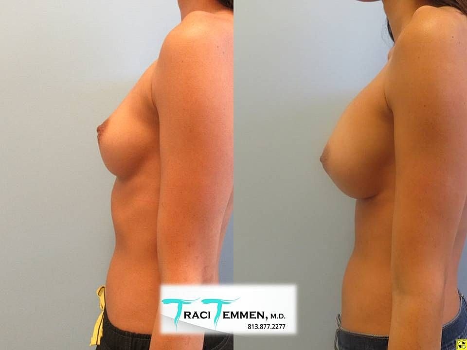 Before and after breast enhancement side view.