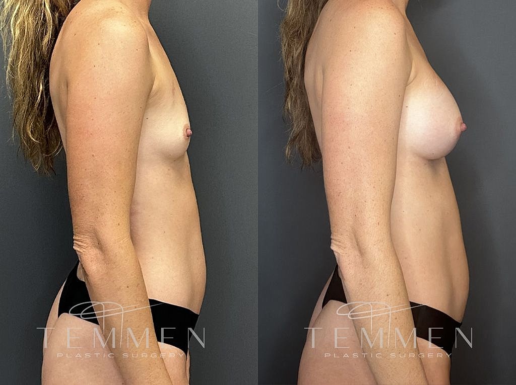 Before and after plastic surgery side profile comparison.