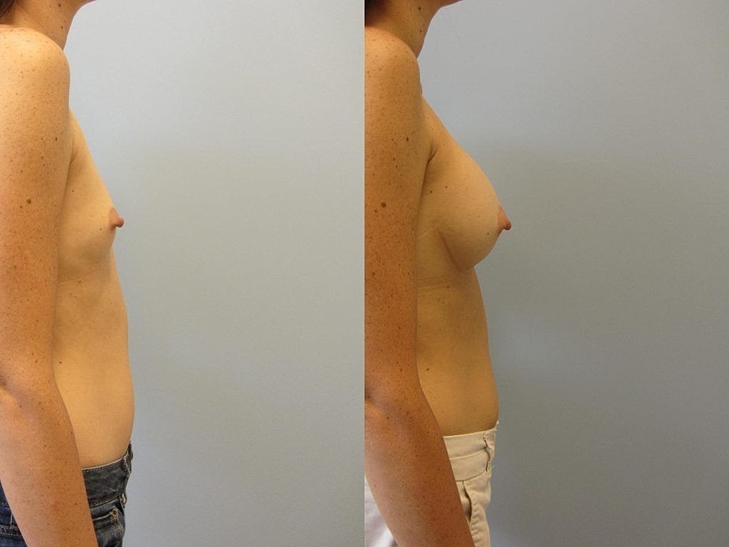 Before and after side profile body comparison.