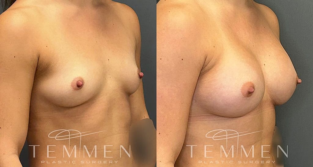 Before and after breast augmentation results.