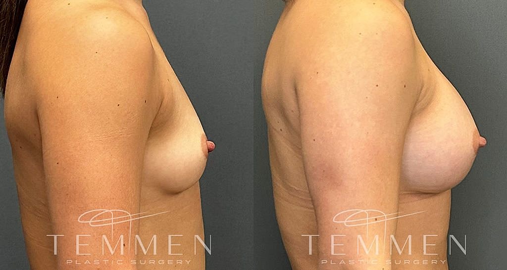 Before and after breast augmentation comparison image.