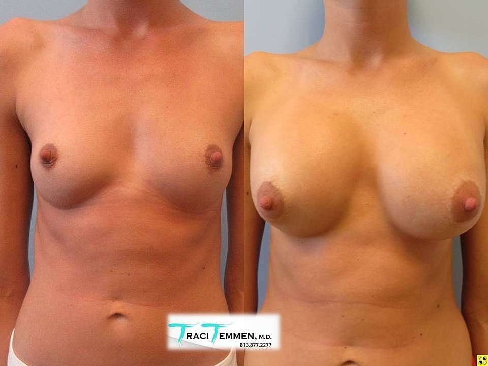 Before and after breast enhancement results.