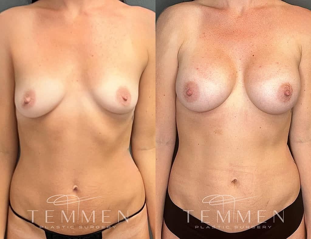 Breast augmentation before and after images.