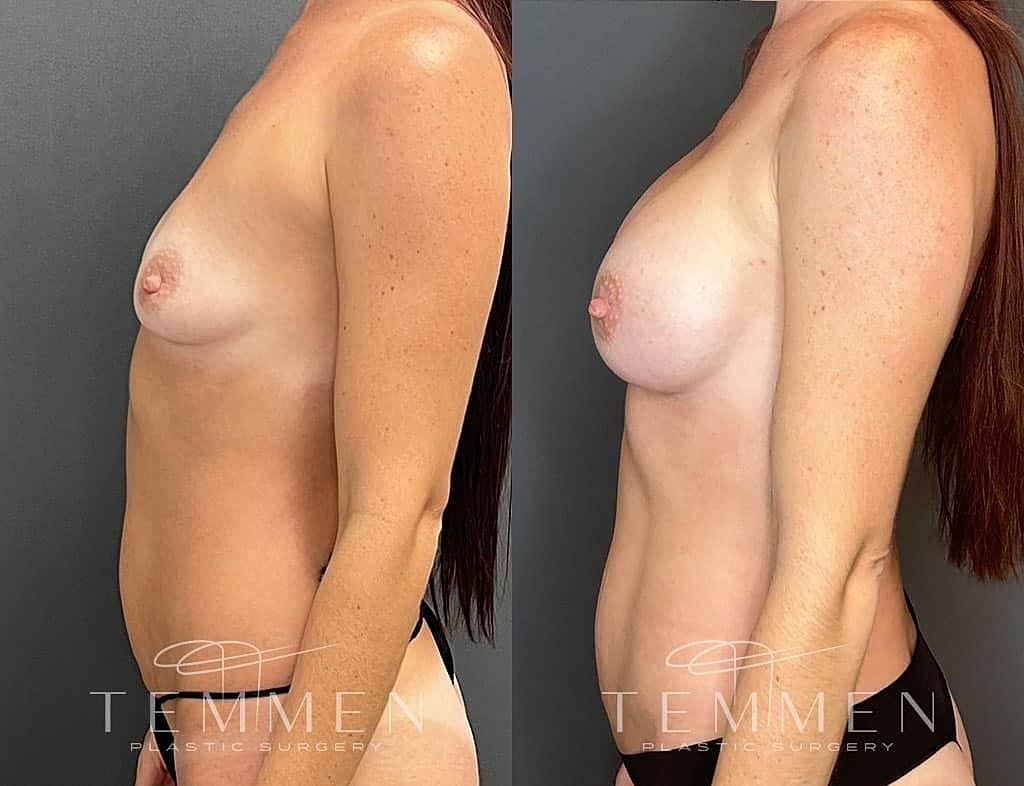 Before and after breast surgery comparison image
