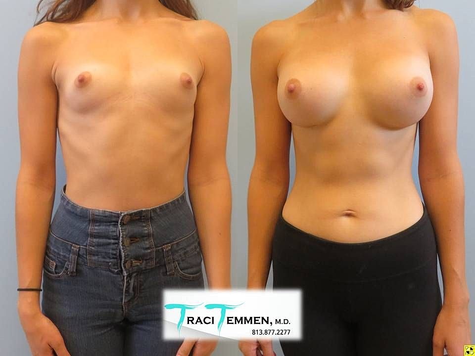 Before and after cosmetic surgery comparison image.