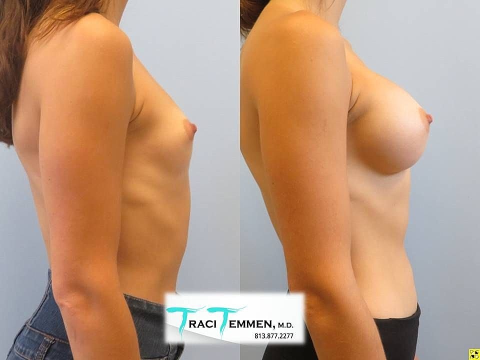 Before and after breast enhancement results.
