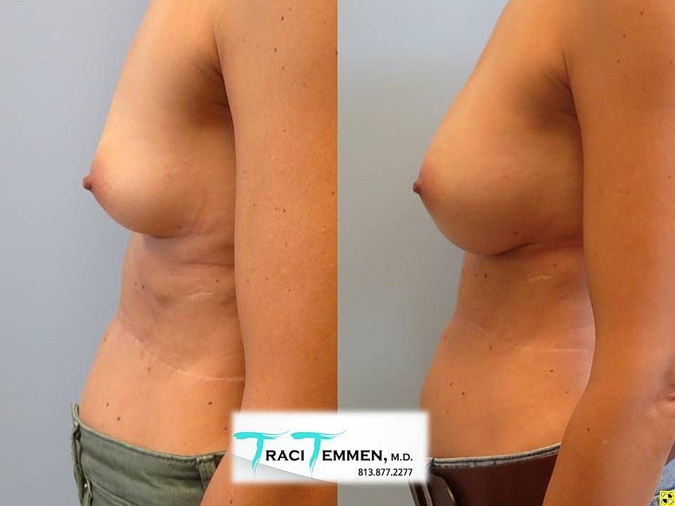 Post-surgery breast enhancement side-by-side comparison.