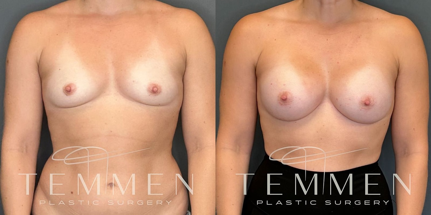 Small Breast Augmentation Before & After