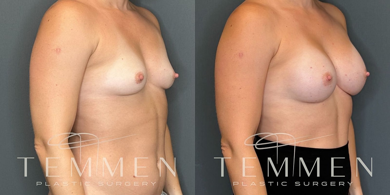 Small Breast Augmentation Before & After