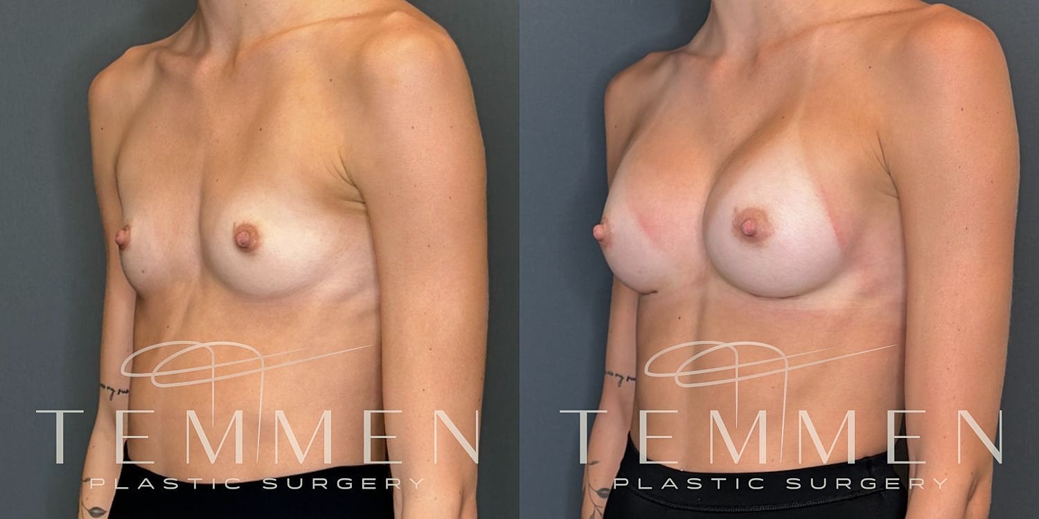 Small Breast Augmentation Before & After