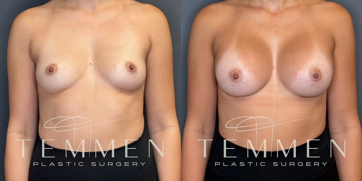 Small Breast Augmentation Before & After