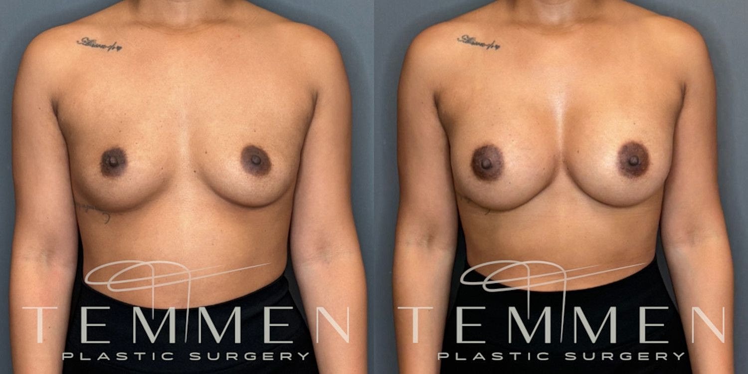 Small Breast Augmentation Before & After