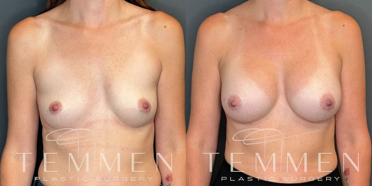 Small Breast Augmentation Before & After