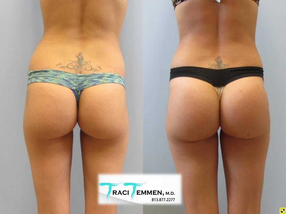 Gluteal Implants Butt Implants Before & After