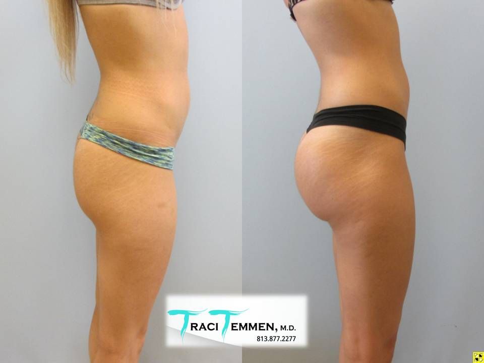 Gluteal Implants Butt Implants Before & After