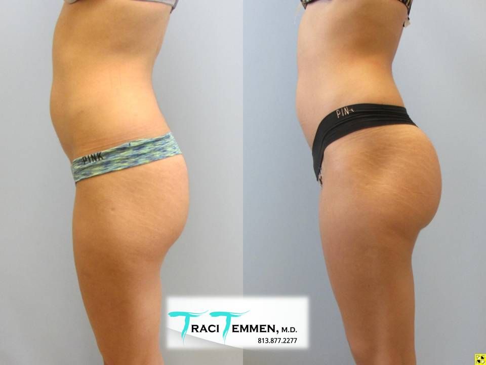 Gluteal Implants Butt Implants Before & After