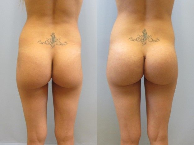 Gluteal Implants Butt Implants Before & After