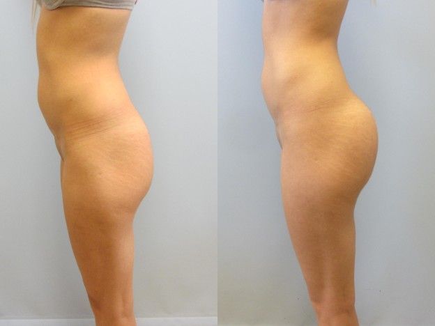 Gluteal Implants Butt Implants Before & After