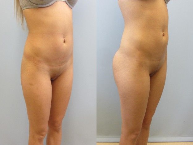 Gluteal Implants Butt Implants Before & After