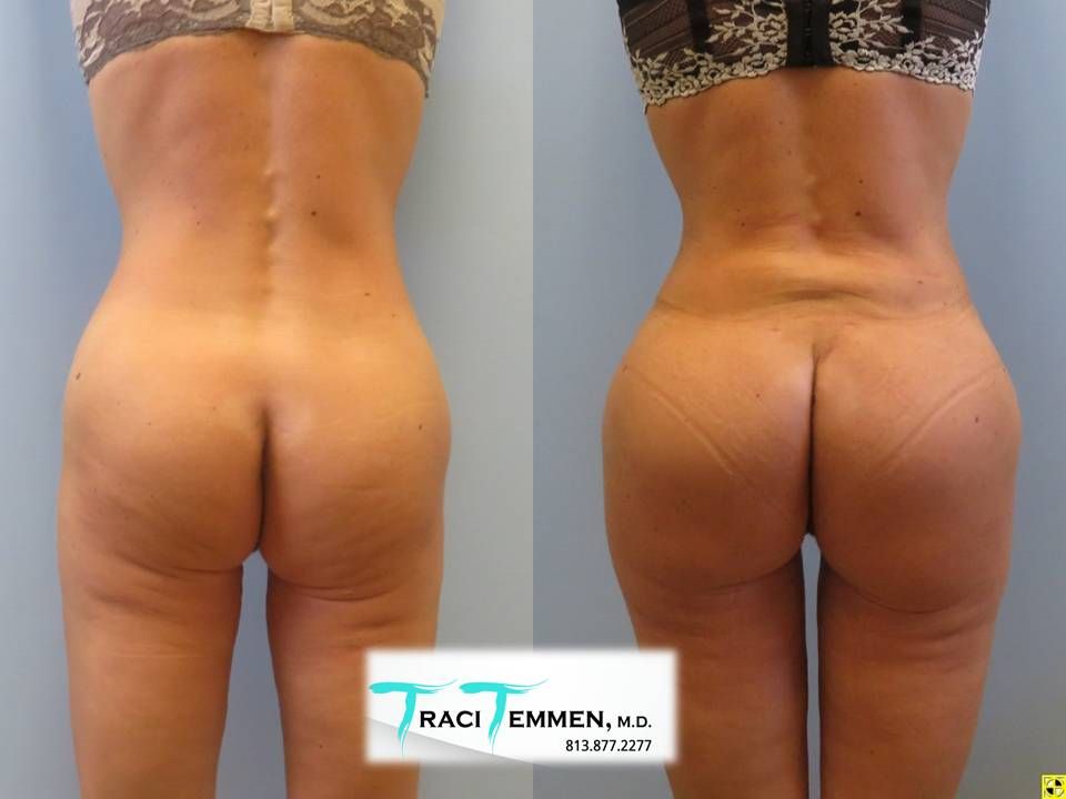 Gluteal Implants Butt Implants Before & After