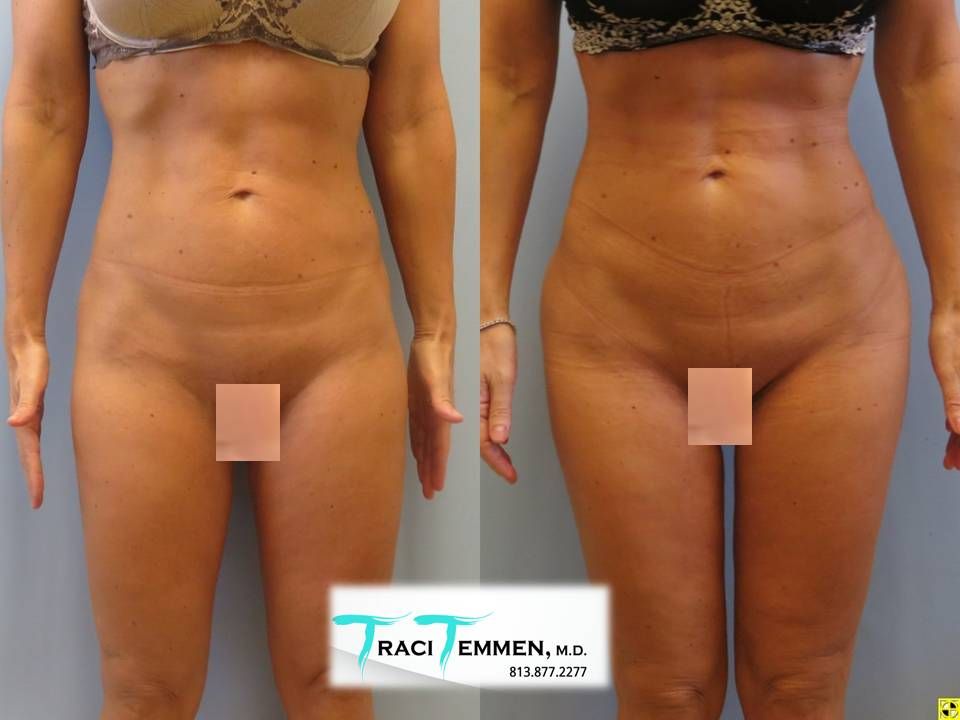 Gluteal Implants Butt Implants Before & After