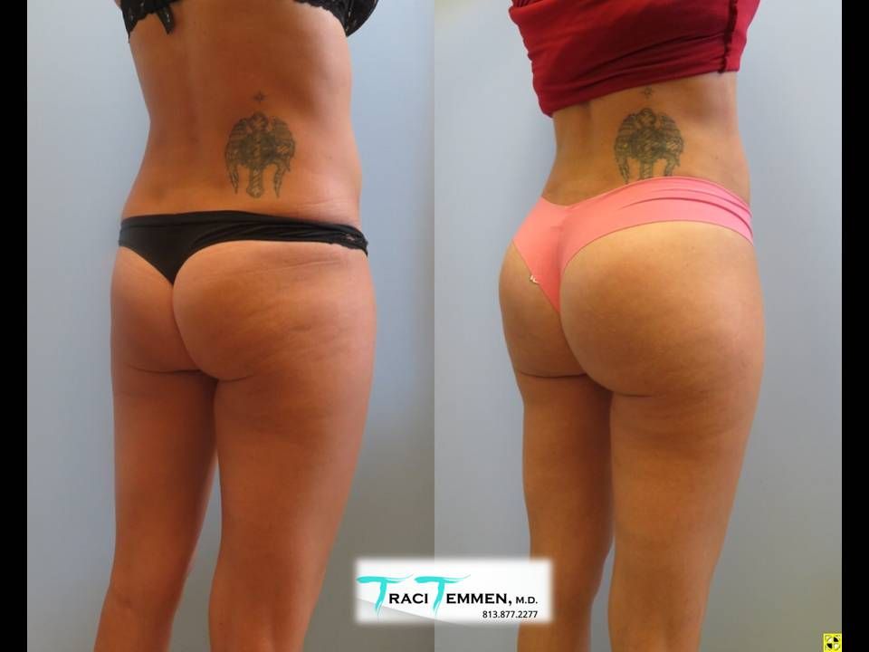 Gluteal Implants Butt Implants Before & After