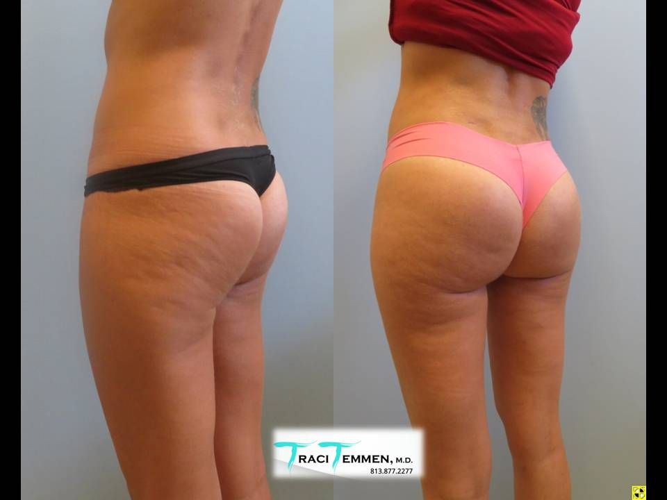 Gluteal Implants Butt Implants Before & After