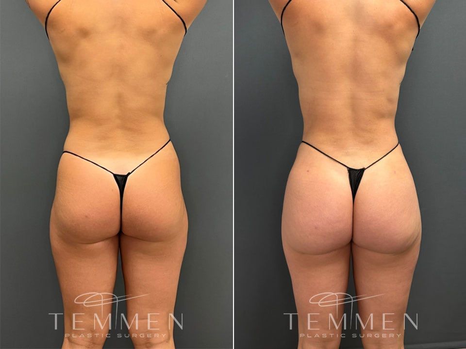 Skinny Brazilian Butt Lift Before & After