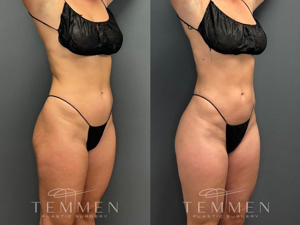 Skinny Brazilian Butt Lift Before & After