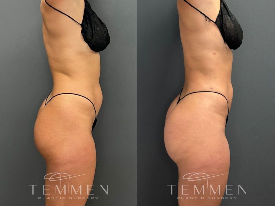 Skinny Brazilian Butt Lift Before & After